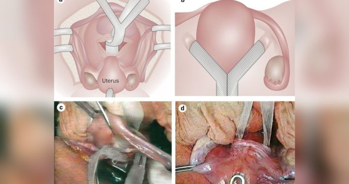 How to Care for Senior Women Following Prolapse Organ Surgery: Essential Tips